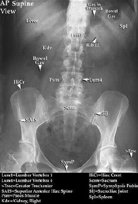 Kub X Ray Labeled What Is Abdominal X Ray Or Kub Medical Anatomy