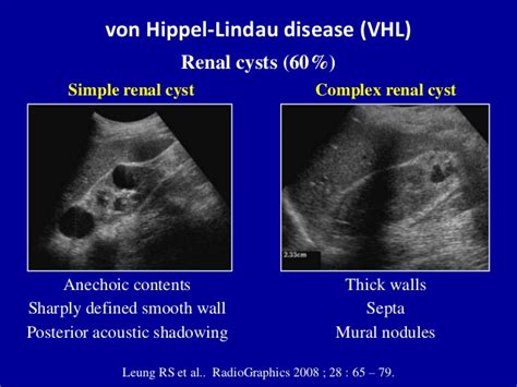 Medical Ultrasoundrenal Cyst