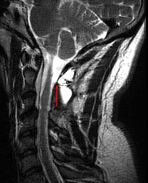 Cureus Repair Of Postoperative Cervical Pseudomeningocele With The