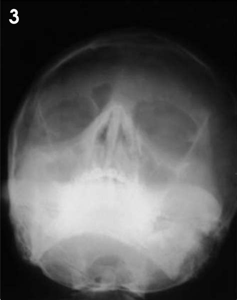 Frontal Sinus X Ray