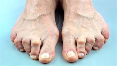 How To Reduce Corns And Calluses On Your Feet Starts At 60