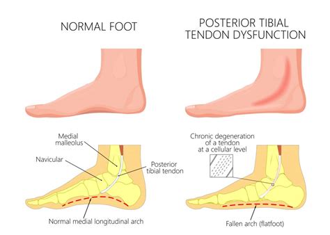 Posterior Tibial Tendon Dysfunction Stages