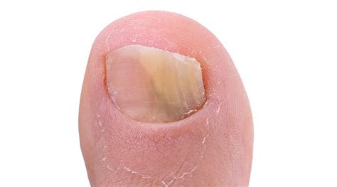 Fungal Nail Infection Dermatology Matters