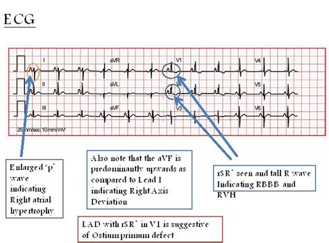 Atrial Septal Defect Electrocardiogram Wikidoc