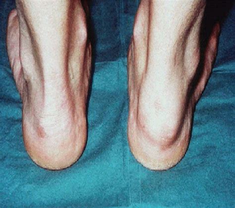 Top 95 Images Pictures Of Psoriatic Arthritis On Legs Full Hd 2k 4k