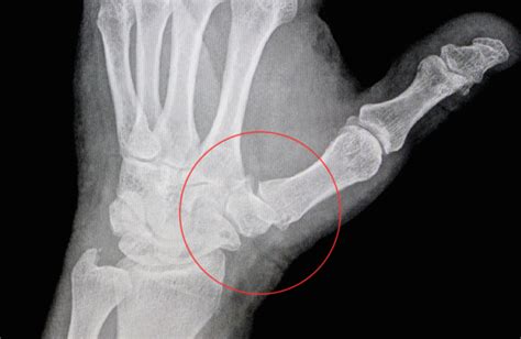 Hand411 What Is Basilar Thumb CMC Arthritis
