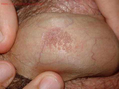 Anal Or Genital Warts Human Papillomavirus Red Book Online