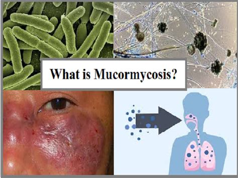Mucormycosis Infection