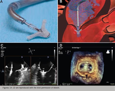Advances In Transcatheter Options In The Management Of Mitral Valve