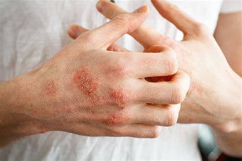 Eczema All You Need To Know About Eczema Page 7 Of 8 Healthella