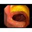 Prepyloric Stomach Ulcer Endoscopic View  Stock Image C033/9776