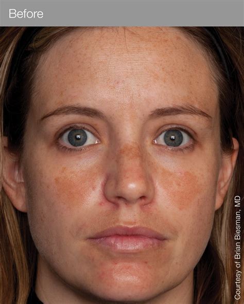 Photos Of Before And After Skin Peels Jan Marini