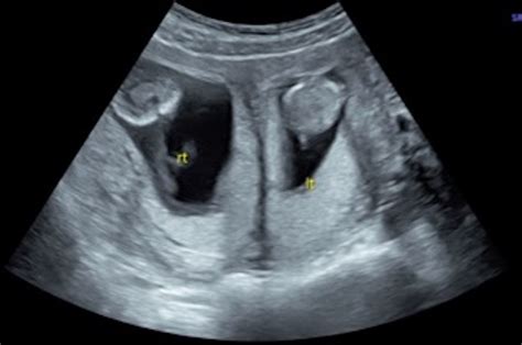 Management Of A Twin Pregnancy In A Didelphys Uterus One Fetus In Each