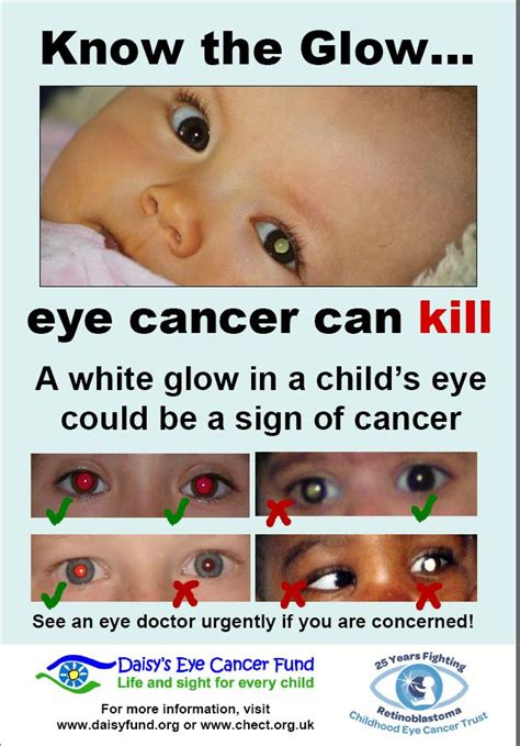 But understanding the warning signs of cancer could save your child's life. Retinoblastoma - Be Child Cancer Aware