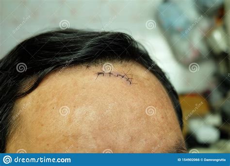 Suture Sewn Seven Stitches On The Head From Accident Head Injury Stock