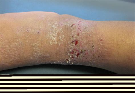 Atopic Dermatitis Atopic Eczema