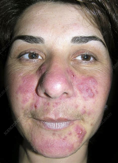 Acne Rosacea On The Face Stock Image C0142529 Science Photo Library