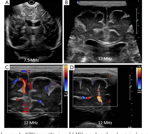 Neonatal Cranial Sonography Ultrasound Findings In Ne