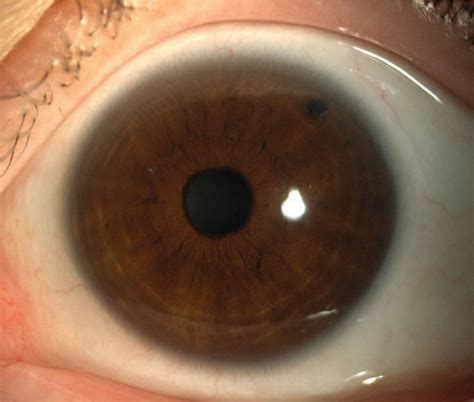 Cataract Surgery Applecross Eye Clinic