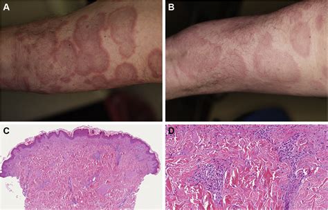 Urticarial Vasculitis Clinical And Laboratory Findings With A