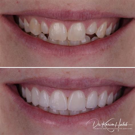Before And After Photos Porcelain Veneers Sydney Cosmetic Dentistry