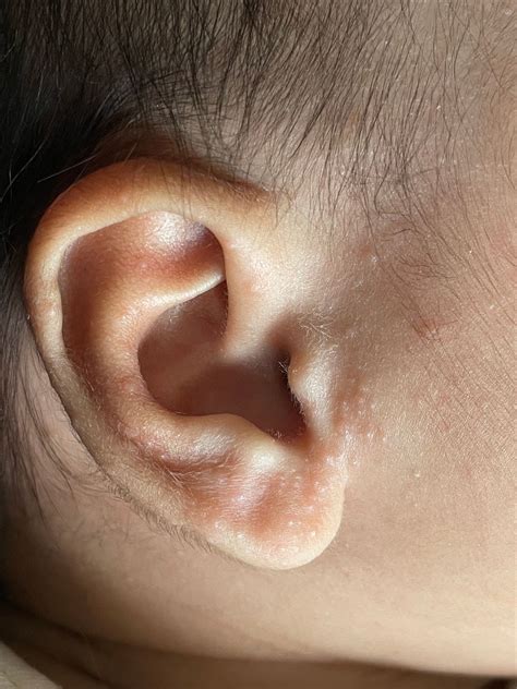 Bumps On Her Ear Babycenter