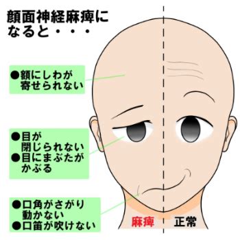 特発性顔面神経麻痺は，突然発症する片側性かつ末梢性の顔面神経麻痺である。 顔面神経麻痺の症状は，顔面上下の半側の麻痺 顔面神経麻痺は臨床的評価に基づいて診断される。 特異的な診断検査はない。 顔面神経麻痺は中枢性顔面神経病変（例，大脳半球の脳卒中または腫. 【大阪市生野区の顔面神経麻痺】クスリが効かない時は東洋 ...