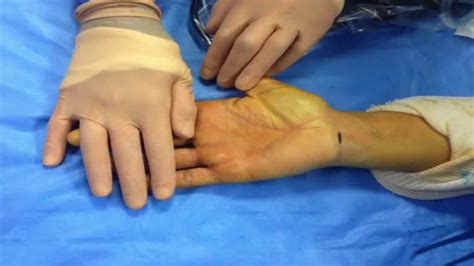 Carpal Tunnel Hand Surgery Toulouse Youtube