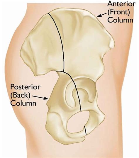 Esclerose No Teto Acetabular