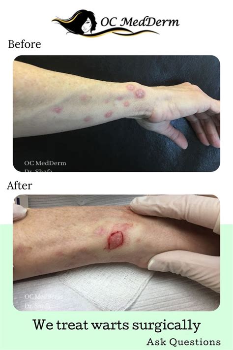 When We Treat Warts Surgically At Oc Medderm In 2022 Topical