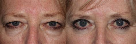 Upper Blepharoplasty Eyelid Lift Pictures 4 Dr Guy Massry