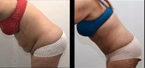 Abdominoplasty Or Tummy Tuck Is A Cosmetic Surgery Procedure For