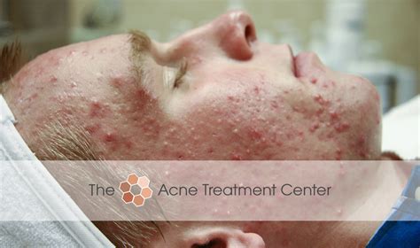 Beforeafter Patient Photos Hyperpigmentation Inflamed Acne The
