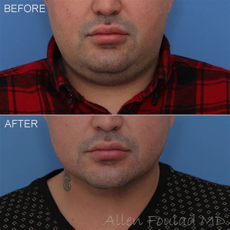Face And Neck Liposuction In Beverly Hills Allen Foulad Md