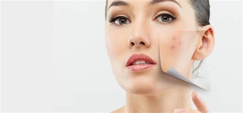 The Solutions To Pimples Acne And Breakouts Skinmiles