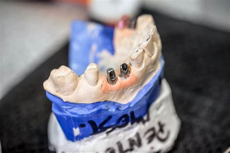 What Is A Dental Implant Healing Cap Somos Dental Downtown Phoenix
