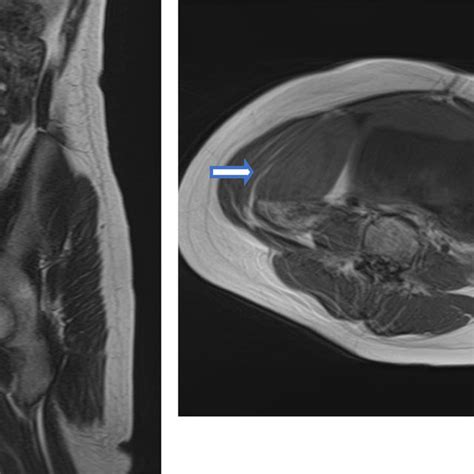 Magnetic Resonance Imaging Left T2 Weighted Imagesagittal Right