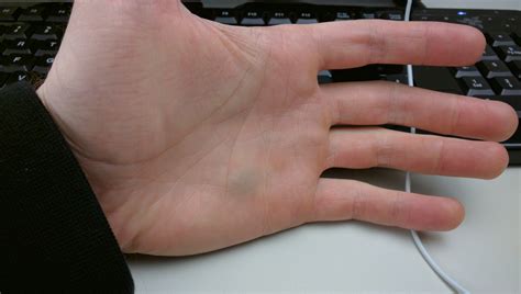 Whats Wrong With My Hand Bruise On Palm Left Of Ringfingerpinky