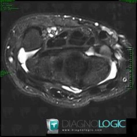 Radiology Case Synovial Cyst MRI Diagnologic
