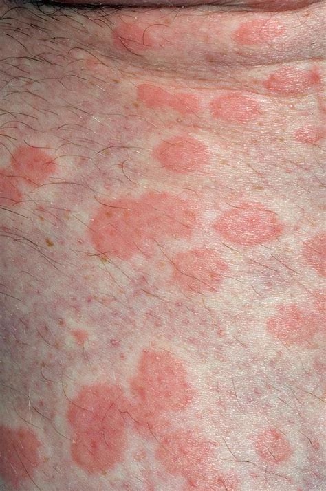 Urticaria Rash On The Skin Photograph By Dr P Marazziscience Photo