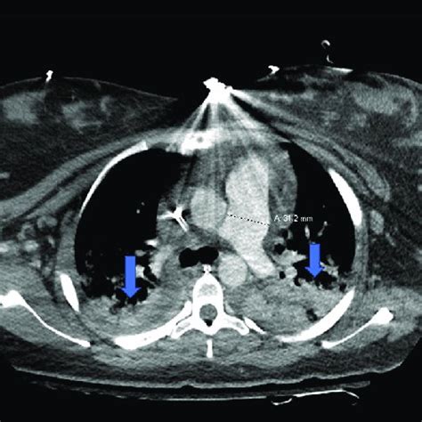Ct Thorax With Contrast Sagittal View Showing Bilateral Opacification