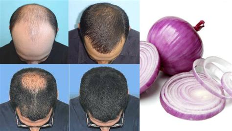 Get Rid Of Hair Loss Using Onion Juice Must Watch Onion Juice Hair