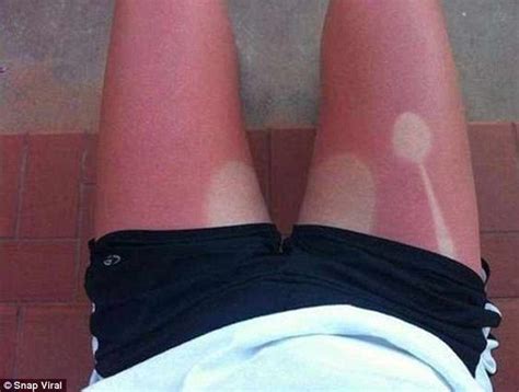 Sunburn Images Show Epic Tan Fails And Bruised Egos To Match Daily