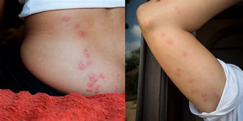 How To Treat Stink Bug Dermatitis Siambookcenter