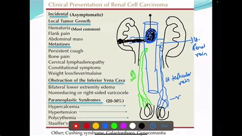 Renal Cell Carcinoma Rcc Part 2 Diagnosis— Clinical Features