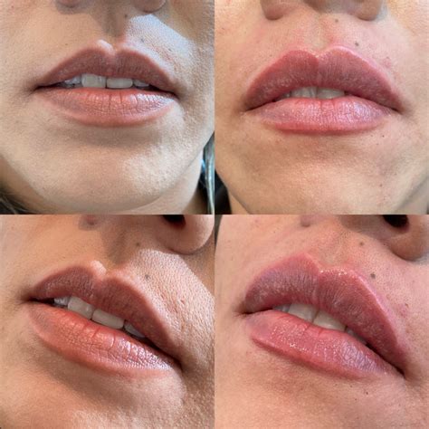 Lip Filler Injections Lip Flip Procedure Laugh Lines Treatment
