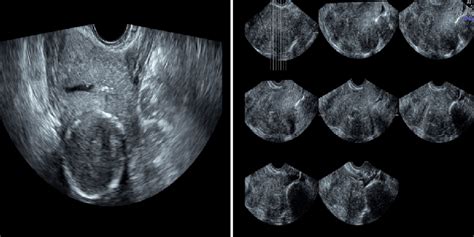 Leiomyomas In Two Dimensional And Tomographic Ultrasound Imaging