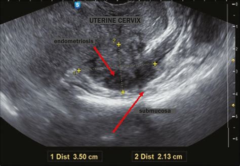 Scielo Brasil Transvaginal Ultrasound In Deep Endometriosis My XXX