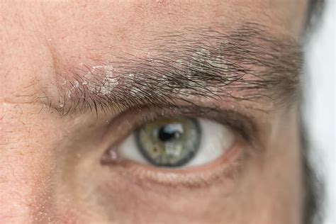 Potential Causes Of Itchy Eyebrows How To Treat Them