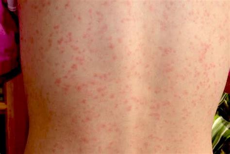 Scarlet Fever Causes Symptoms Treatment And Complications